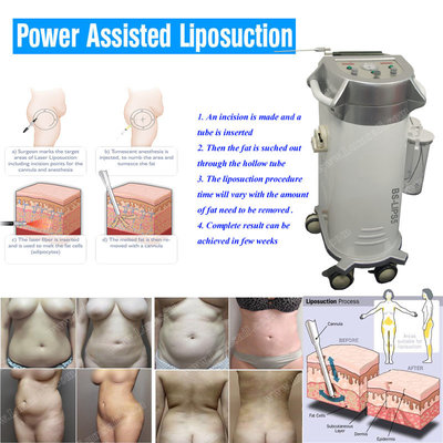 China BS-LIPS5 cannula sales body slimming power assisted liposuction machine supplier