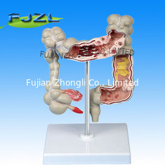 China Pathological Model of Colon and Rectum,colon model supplier