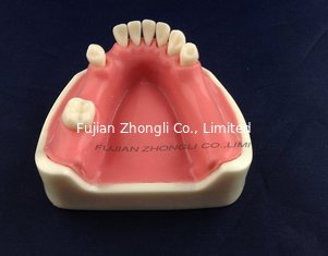 China dental implant model with soft gingiva for practice supplier
