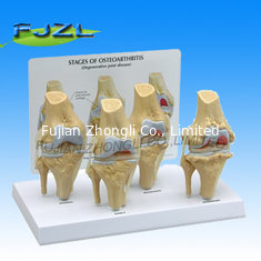 China 4-Stage Osteo-Arthritic Knee Anatomical Model Anatomical Model supplier