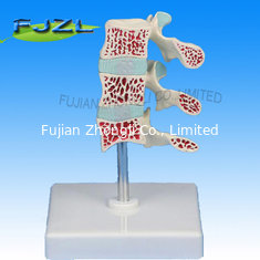 China Deluxe Osteoporosis Model (3 Vertebrae) supplier
