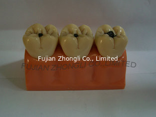 China Dental 4 times size caries demonstrating model supplier