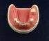 dental implant model with soft gingiva for practice supplier