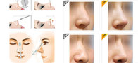 2ml HA gel for lip and nose enhancement, HA gel dermal filler for beauty
