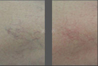 Red Vein Removal Machine , Face / Leg Veins Treatment for Clinic and Salon
